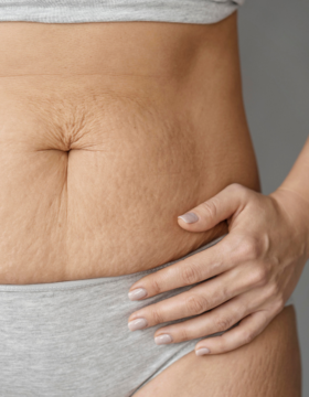 Remodelación Corporal y Eliminación de Celulitis